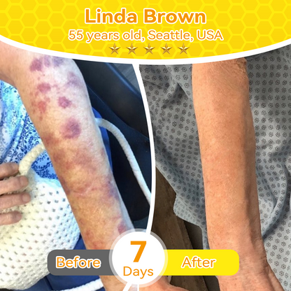 🇺🇸𝑶𝒇𝒇𝒊𝒄𝒊𝒂𝒍 𝑺𝒕𝒐𝒓𝒆|𝑺𝒂𝒃𝒂𝒙® 𝐁𝐞𝐞 𝐕𝐞𝐧𝐨𝐦 & 𝐖𝐡𝐢𝐩𝐩𝐞𝐝 𝐓𝐚𝐥𝐥𝐨𝐰 𝐁𝐚𝐥𝐦 Skin Repair Cream (𝐉𝐮𝐬𝐭 𝐨𝐧𝐜𝐞 𝐚 𝐝𝐚𝐲, 𝐯𝐢𝐬𝐢𝐛𝐥𝐞 𝐜𝐡𝐚𝐧𝐠𝐞𝐬 𝐢𝐧 𝟕 𝐝𝐚𝐲𝐬） ✅ Targets Age Spots, Wrinkles, Eczema, Redness, Stretch Marks, and Even Joint Issues.