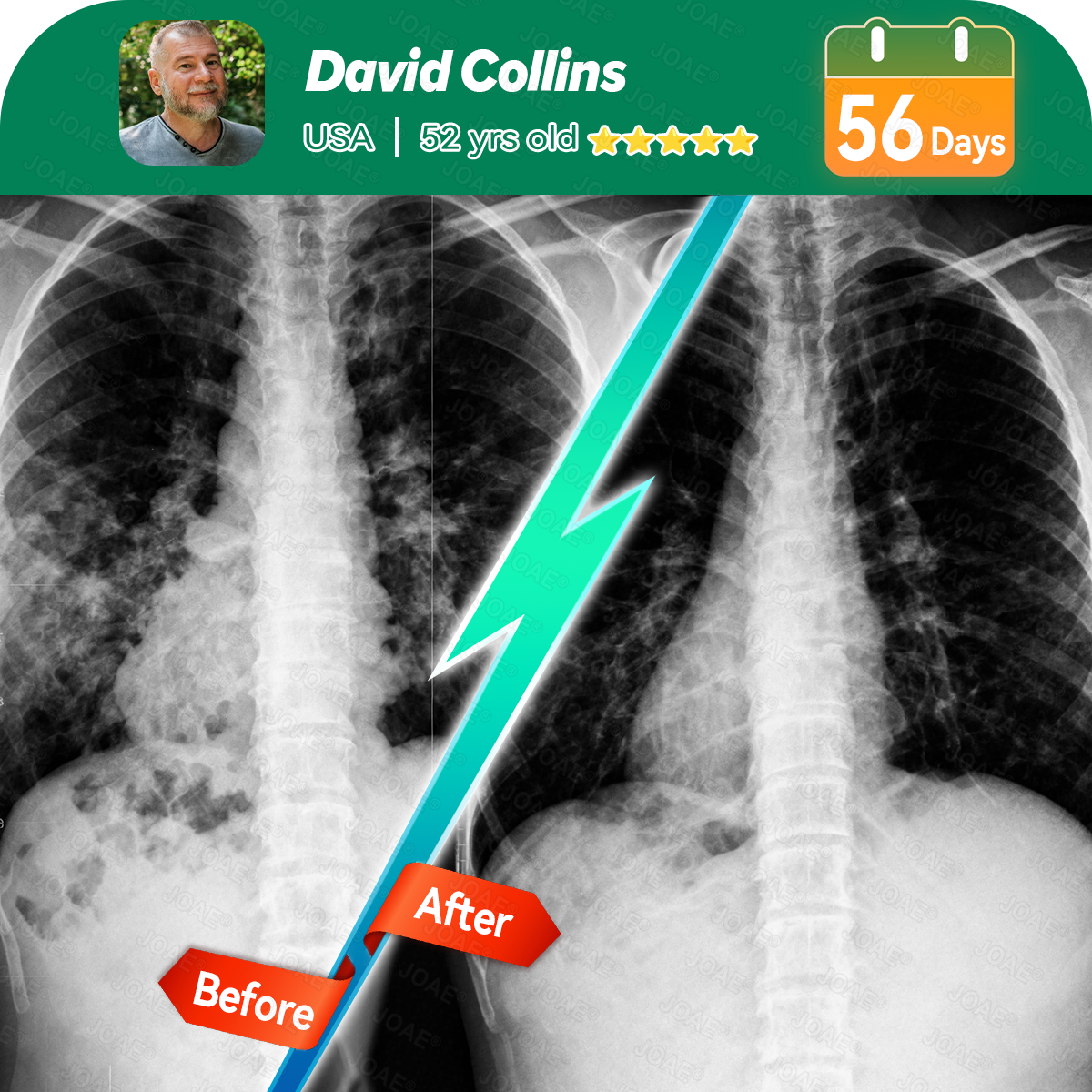 🌿FDA Approved|𝐉𝐎𝑨𝑬®COPD Relief – Mullein Lung Cleanse Oral Liquid(💝 Cough, wheezing, shortness of breath, sputum, stuffy nose, bronchitis, bronchitis, allergy symptoms, lung discomfort🫁)