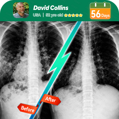 🌿FDA Approved|𝐉𝐎𝑨𝑬®COPD Relief – Mullein Lung Cleanse Oral Liquid(💝 Cough, wheezing, shortness of breath, sputum, stuffy nose, bronchitis, bronchitis, allergy symptoms, lung discomfort🫁)