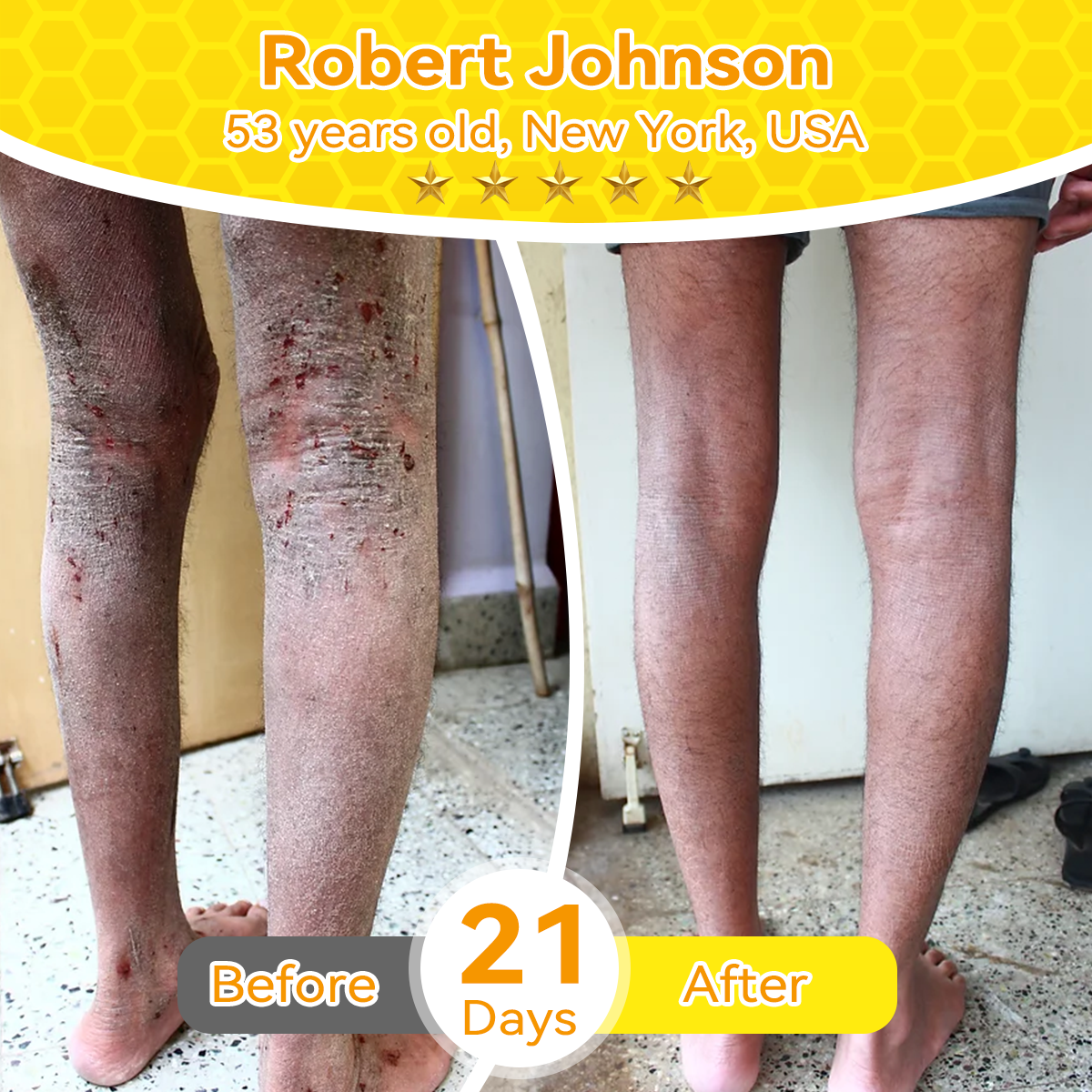 🇺🇸𝑶𝒇𝒇𝒊𝒄𝒊𝒂𝒍 𝑺𝒕𝒐𝒓𝒆|𝑺𝒂𝒃𝒂𝒙® 𝐁𝐞𝐞 𝐕𝐞𝐧𝐨𝐦 & 𝐖𝐡𝐢𝐩𝐩𝐞𝐝 𝐓𝐚𝐥𝐥𝐨𝐰 𝐁𝐚𝐥𝐦 Skin Repair Cream (𝐉𝐮𝐬𝐭 𝐨𝐧𝐜𝐞 𝐚 𝐝𝐚𝐲, 𝐯𝐢𝐬𝐢𝐛𝐥𝐞 𝐜𝐡𝐚𝐧𝐠𝐞𝐬 𝐢𝐧 𝟕 𝐝𝐚𝐲𝐬） ✅ Targets Age Spots, Wrinkles, Eczema, Redness, Stretch Marks, and Even Joint Issues.