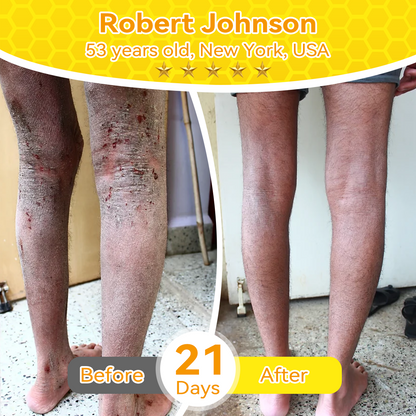 🇺🇸𝑶𝒇𝒇𝒊𝒄𝒊𝒂𝒍 𝑺𝒕𝒐𝒓𝒆|𝑺𝒂𝒃𝒂𝒙® 𝐁𝐞𝐞 𝐕𝐞𝐧𝐨𝐦 & 𝐖𝐡𝐢𝐩𝐩𝐞𝐝 𝐓𝐚𝐥𝐥𝐨𝐰 𝐁𝐚𝐥𝐦 Skin Repair Cream (𝐉𝐮𝐬𝐭 𝐨𝐧𝐜𝐞 𝐚 𝐝𝐚𝐲, 𝐯𝐢𝐬𝐢𝐛𝐥𝐞 𝐜𝐡𝐚𝐧𝐠𝐞𝐬 𝐢𝐧 𝟕 𝐝𝐚𝐲𝐬） ✅ Targets Age Spots, Wrinkles, Eczema, Redness, Stretch Marks, and Even Joint Issues.