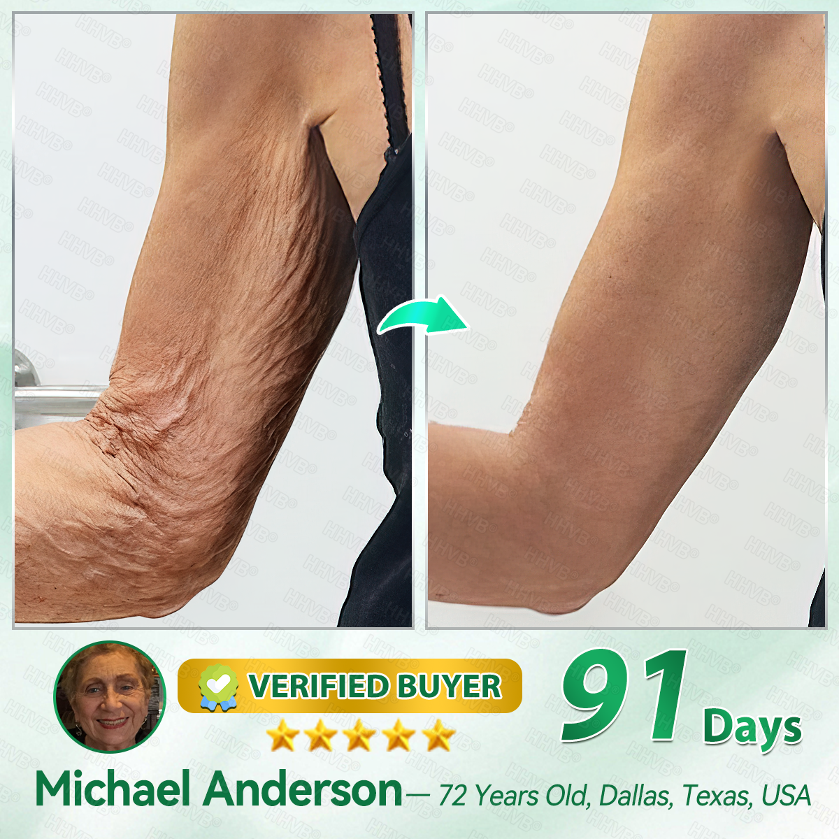 🇺🇸FDA|𝙃𝙃𝙑𝘽®𝐑𝐞𝐭𝐢𝐧𝐨𝐥 + 𝐂𝐨𝐥𝐥𝐚𝐠𝐞𝐧 𝐀𝐧𝐭𝐢-𝐖𝐫𝐢𝐧𝐤𝐥𝐞 & 𝐅𝐢𝐫𝐦𝐢𝐧𝐠 𝐒𝐞𝐫𝐮𝐦 𝐒𝐚𝐜𝐡𝐞𝐭𝐬 (𝐉𝐮𝐬𝐭 𝐨𝐧𝐜𝐞 𝐚 𝐝𝐚𝐲, 𝐯𝐢𝐬𝐢𝐛𝐥𝐞 𝐜𝐡𝐚𝐧𝐠𝐞𝐬 𝐢𝐧 𝟕 𝐝𝐚𝐲𝐬） ✅ Improves sagging skin on the face, neck, arms, abdomen, and buttocks, while reducing dark spots and discoloration